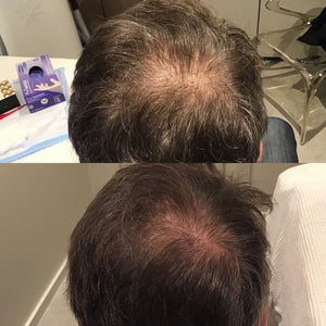 Scalp and Hair Growth Serum by Keravive