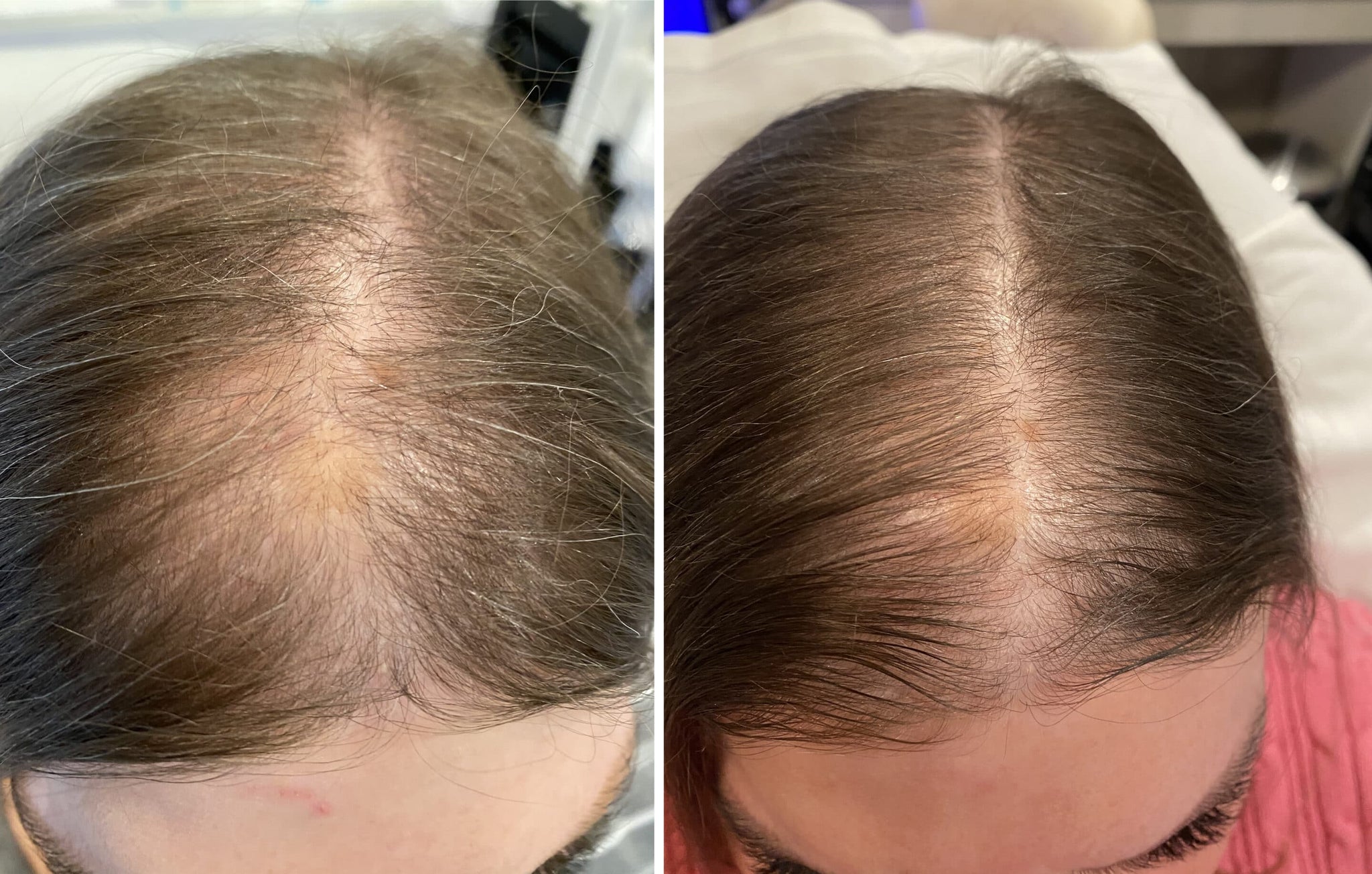 Scalp and Hair Growth Serum by Keravive