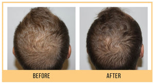 Scalp and Hair Growth Serum by Keravive
