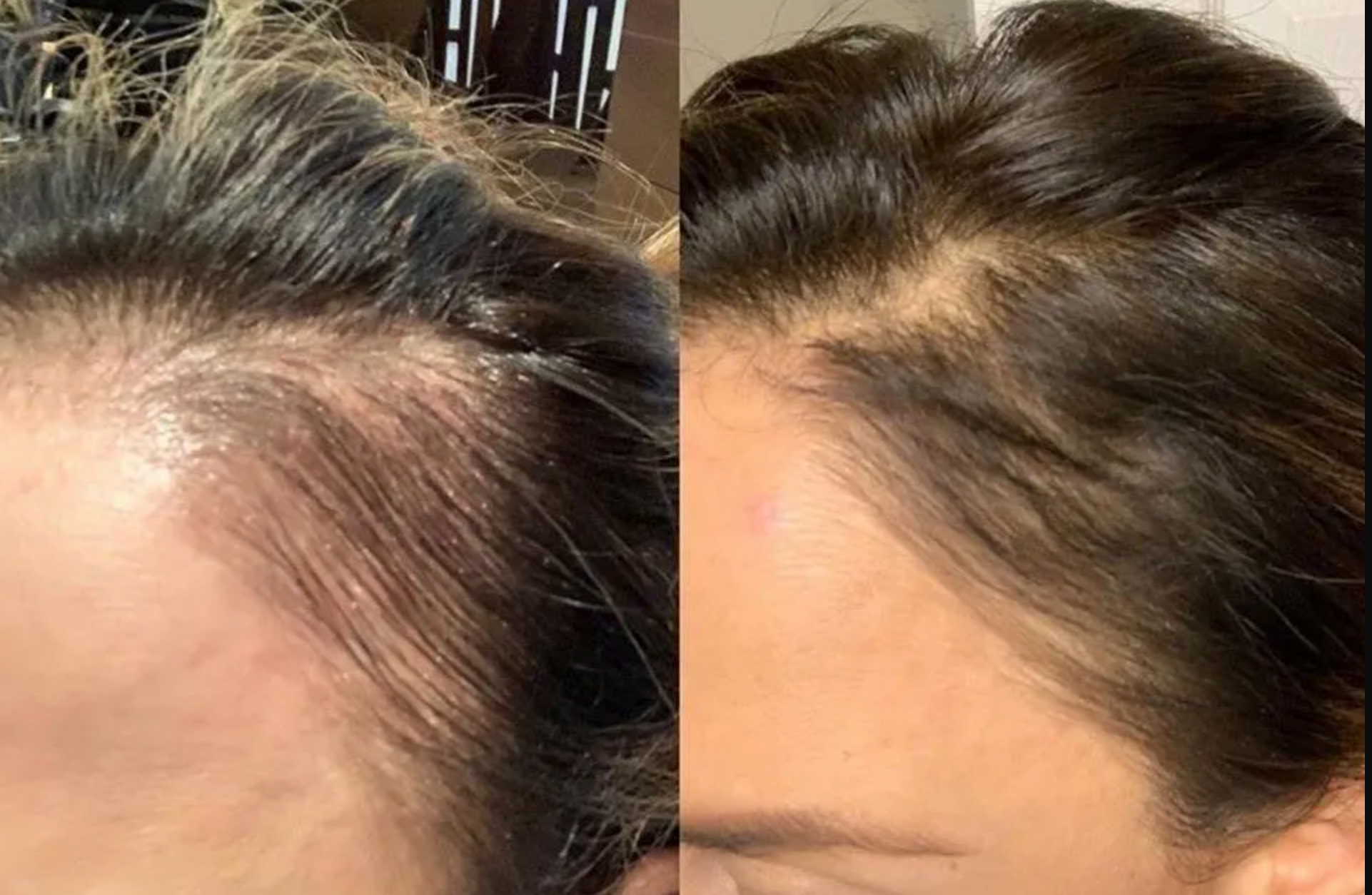 Scalp and Hair Growth Serum by Keravive
