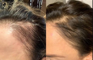 Scalp and Hair Growth Serum by Keravive
